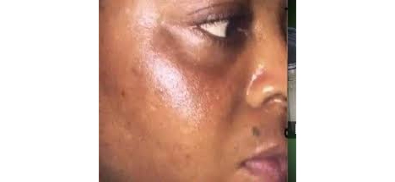How to Prevent and Manage Sunburn and Dark Under-Eye Circles